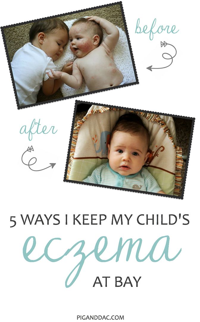 How I keep my child's eczema at bay, especially during these hot, dry summer months